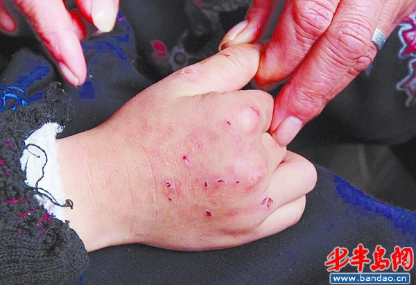 魯博城不高興時會抓自己的小手，抓出了不少傷痕